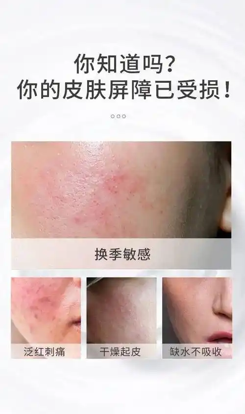 用啥都过敏皮肤换季就发痒红干可能是