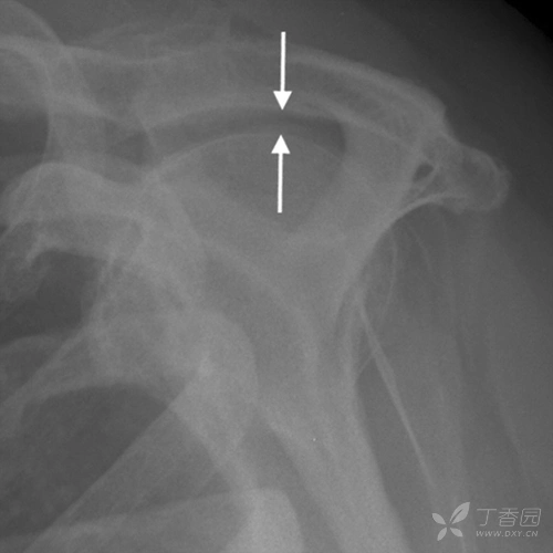 a-h间距测量值为x线图像中测得的肱骨头顶与肩峰端前外下角之间的垂直