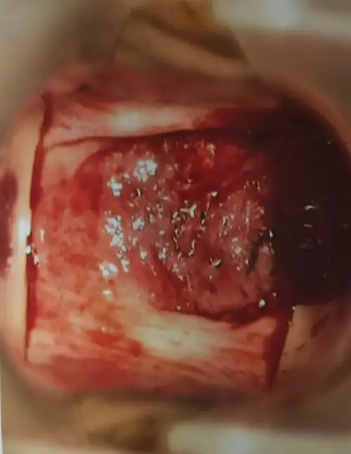 女性如何预防宫颈癌?