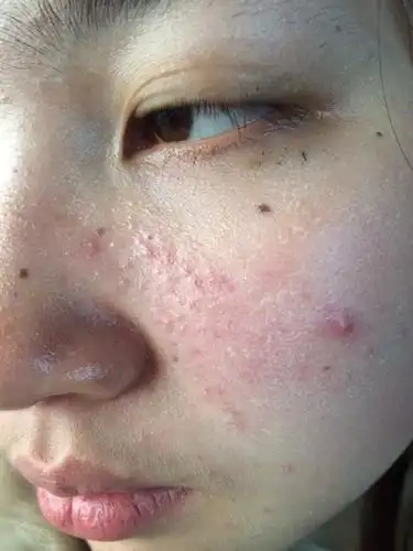 脸上长痘痘五年,用过很多药一直不好,皮肤严重受损,高敏感,,怎么办?