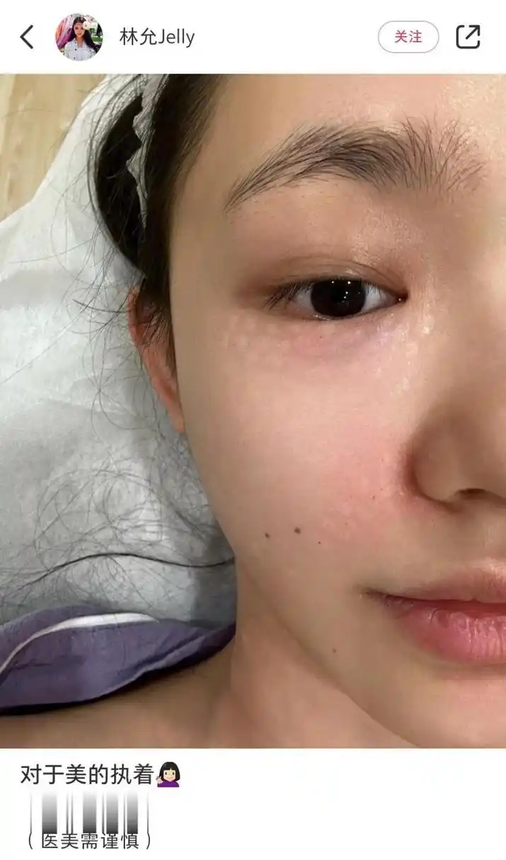 林允晒自己做医美的照片,上面密密麻麻的针眼痕迹触目惊心.