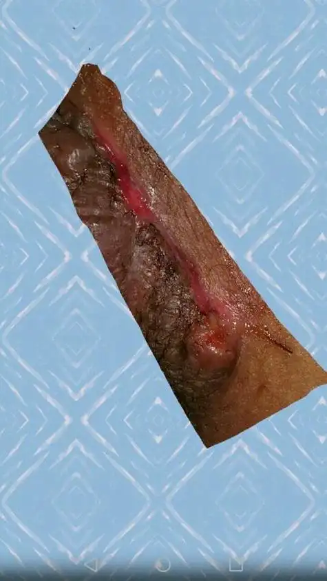 侧切伤口肿痛正常吗(侧切伤口肿痛怎么办)