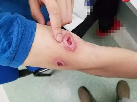 身上多个部位溃疡是什么病