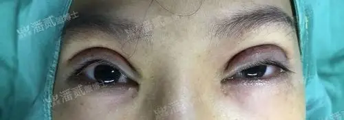 一般来说修复会先提肌,提肌矫正后修复双眼皮,双眼皮缝合结束后再填