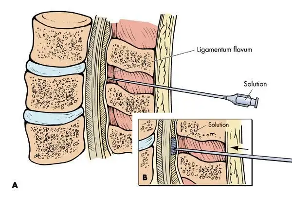 骶裂孔畸形占10%,骶裂孔闭合占5%,位置也有高低之分,所以在治疗前做病