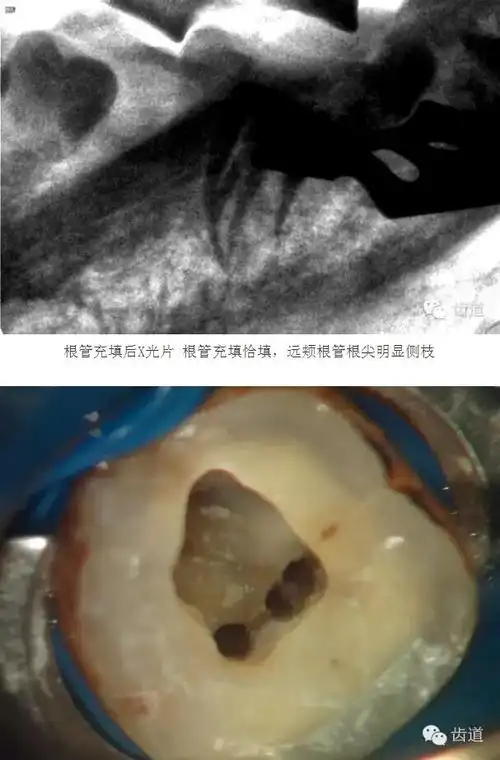 下颌第二磨牙的根管类型3 根 管 54.3%;c型根管 31.