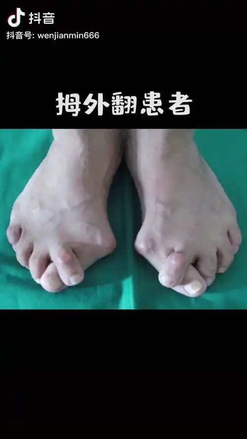 不去zl,拇外翻长期发展下去,但是后果还是很严重的拇外翻 脚丫子 骨科