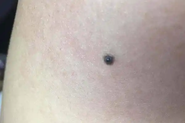 是老人说的"苦情痣"?真相是怎样的?