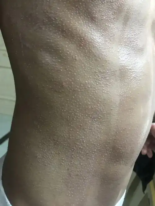 孩子14岁身上长了好多疙瘩,医生说是湿疹,有没有什么好的解决方法啊