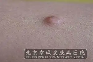 皮肤纤维瘤的罕见病因有哪些