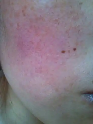 用新的护肤品都十天了脸上过敏很严重,请问是不是新的护肤品原因,还有