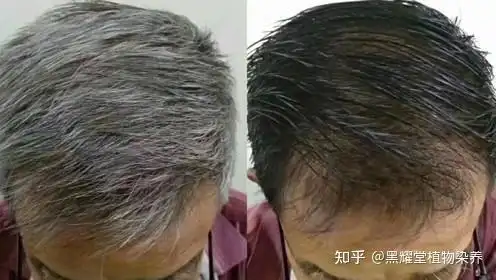 白发变黑不困难找准原因对症下药