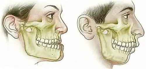 朱石江做颌面畸形矫正手术厉害,擅长凸嘴/偏颌矫正,下颌前突-8682赴韩