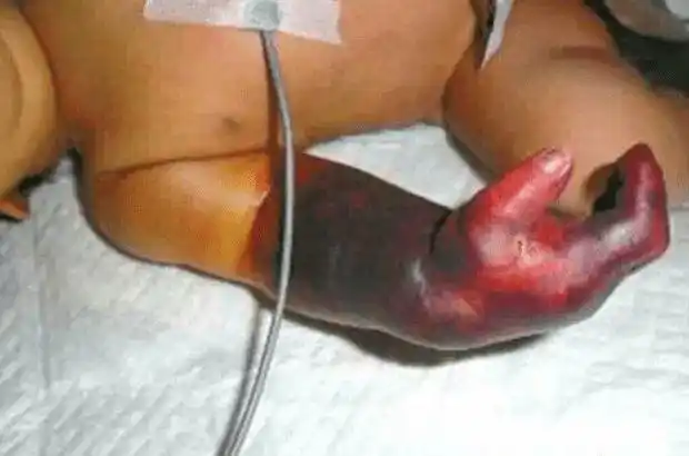 宝宝手指小伤变截肢,奶奶悔断肠!这些习惯太可恨