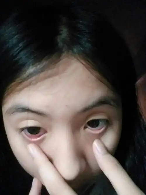 眼睛一个血丝多,一个不会,下眼皮一个红红的充满血丝,一个没有血色,有