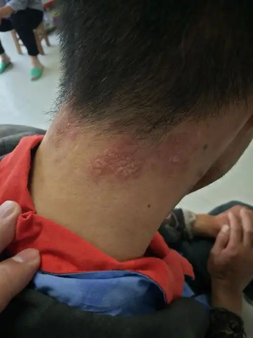 慢性日光性皮炎(慢光化)