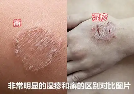 湿疹和癣的区别图片区分图对比