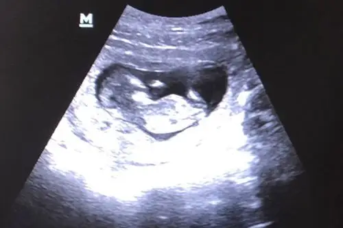 生了女孩的nt图片弯着就是男孩平是女孩吗2