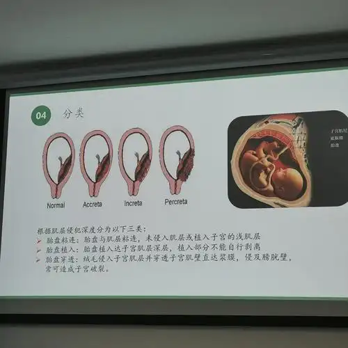 胎盘植入超声诊断