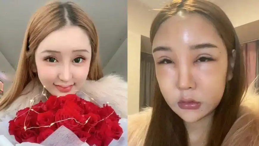 女网红整容上瘾,花费百万整容失败,如今毁容严重连亲妈都认不出