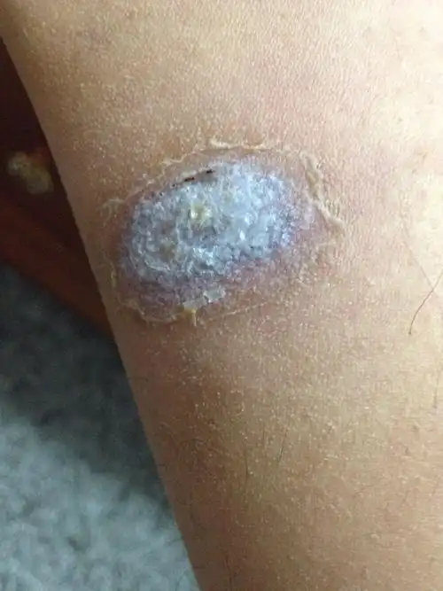 第一张洗澡前第二张洗澡后 为什么差别这么大 还有用什么可以去调癣痕