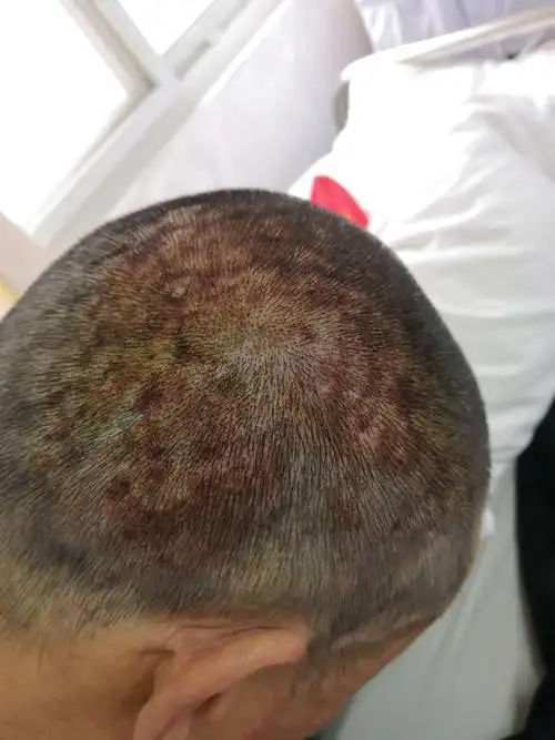 硫酸侵蚀患者 写美篇患者情况:因稀硫酸和偏钒侵蚀,致使整个头皮皮疹