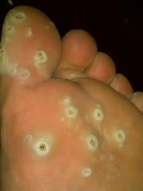 鸡眼是什么样的图片