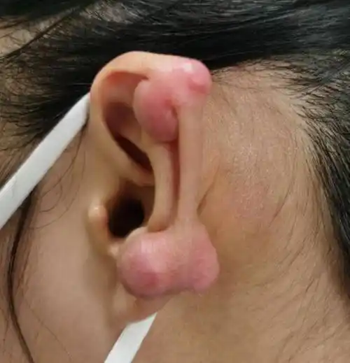 耳朵上挂了个肉疙瘩医生提醒这种体质的人要小心