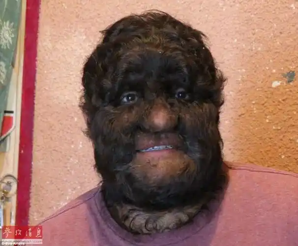 滚动新闻 编辑:肖芬 关键词:多毛症;遗传;毛发;单