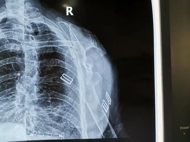 右肩关节斜位片