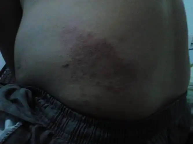 皮肤外科请教各位这是什么皮肤病啊