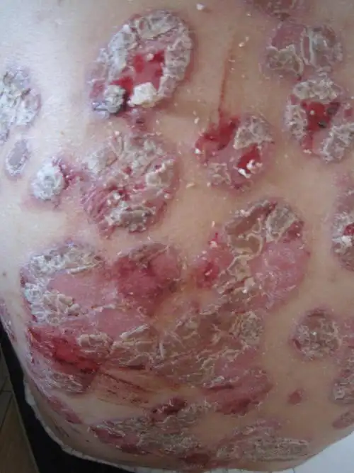 牛皮癣该如何治疗?