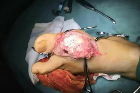 尿酸高从来不用药,身体多个部位出现痛风石时,医生实行了手术切除术