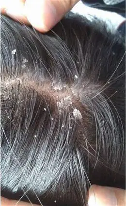 人为什么会有头皮屑是怎么产生的该如何防治