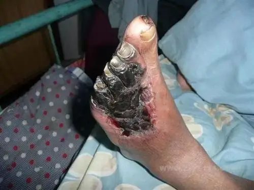 直播预告从血糖高到糖尿病足您离这个可导致截肢的恐怖并发症到底有