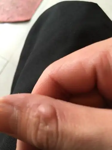 手上起了一个像茧一样的东西,不疼不痒,越来越大,请问这是什么?