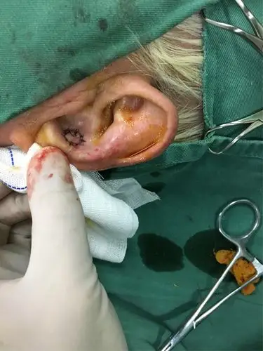 写美篇  虽然此例手术比较简单,但这种修复对于耳廓前方肿物的修复很