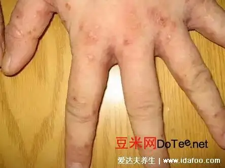 疥疮图片和症状图片