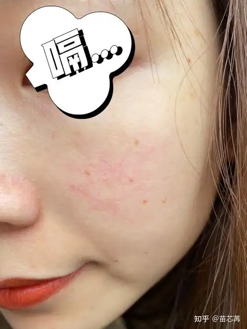 脸上角质层薄,特别容易脸红,怎么办?有好用的护肤品么? - 知乎