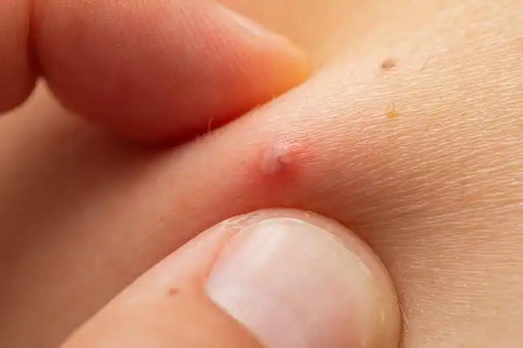 毛囊炎就是毛囊发炎的疾病,受细菌或真菌感染而成,最常见引起毛囊炎的