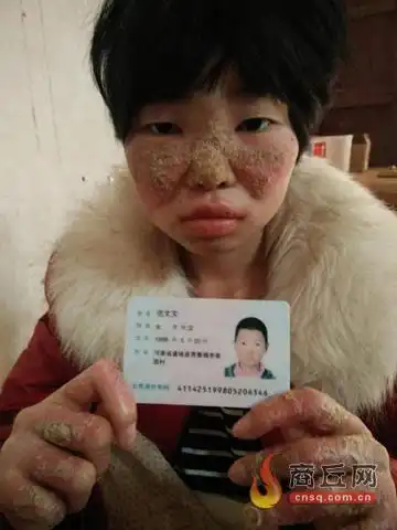 身患严重皮肤病 花季少女十多年不愿出门