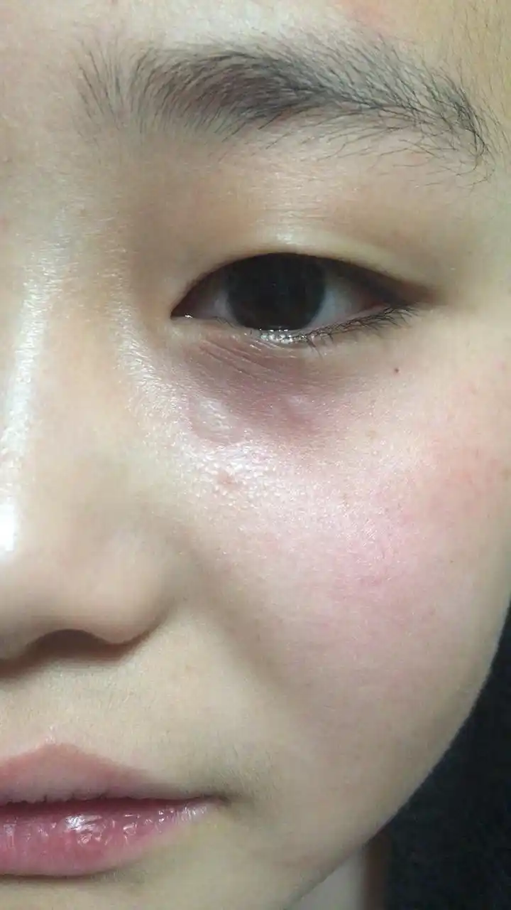 眼睛下边的泡泡是怎么回事?