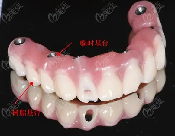 allon4桥架式半口即刻负重种植牙多少钱要清楚它的优缺点也要搞懂