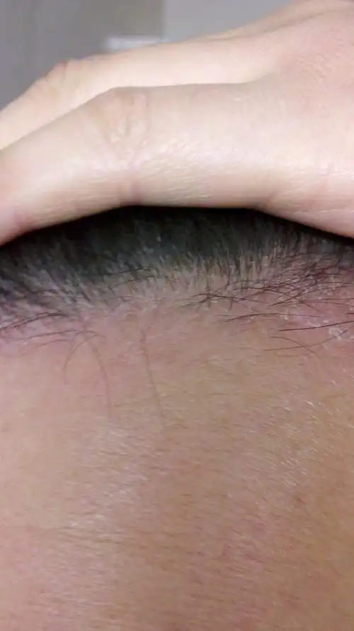 分类:其他2013-11-16 11:57 病情分析: 这种情况可能是由于真菌感染