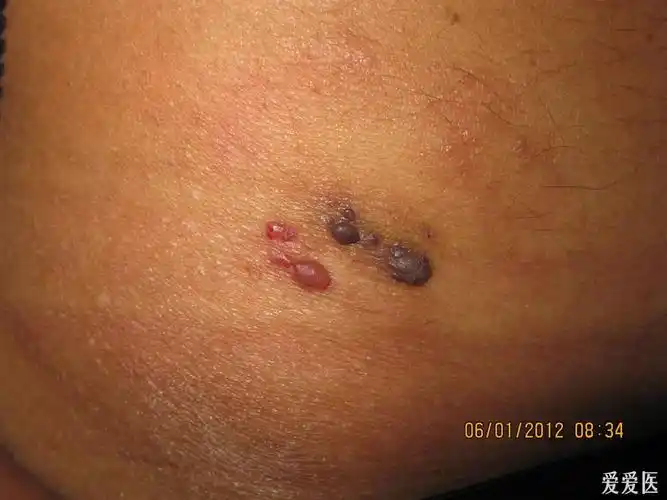 典型病例-------------血管痣