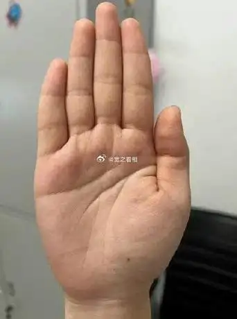 金星丘有痣,事业上容易得到配偶比较大的帮助,容易嫁给