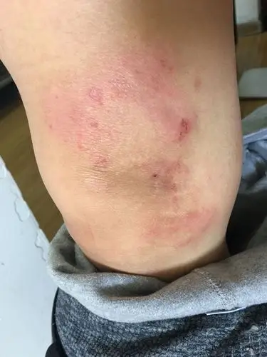 2018-01-08   最佳答案 体癣,外涂达克宁!