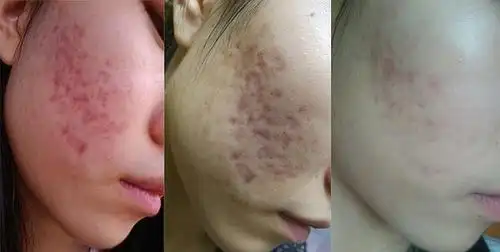 【为自己带盐】从内调说祛痘!6年战痘经历全分享.