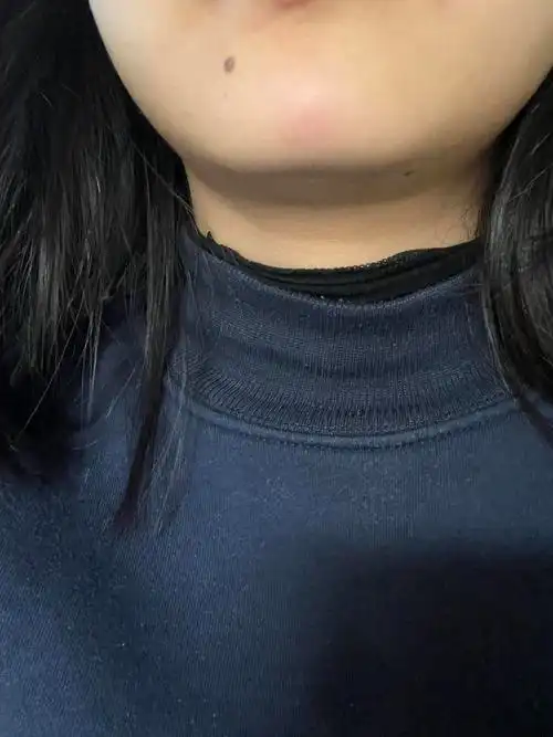 姐妹们下巴长了个大包是啥?痘吗?