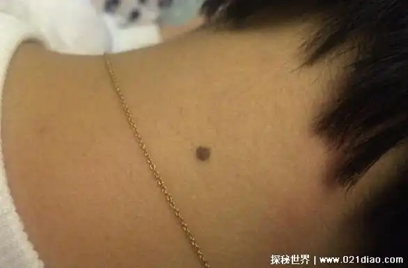脖子后面有痣代表什么意思,男女有痣都说明人旺运势好